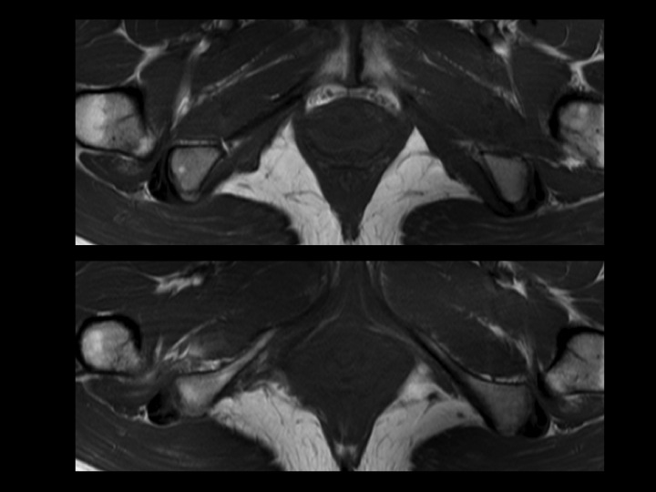 Figure 2 for case ischiofemoral impingement